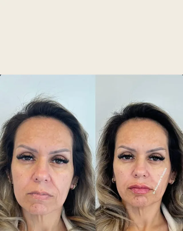 Resultado real de harmonização facial na Clínica Living